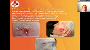 Школа здоровья онлайн. Тема занятия "Рак кожи".