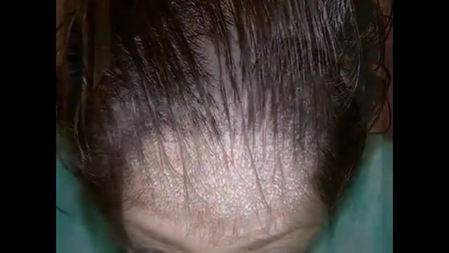 Haartransplantation mit 2504 Grafts bei einem weiblichen Patienten смотреть онлайн