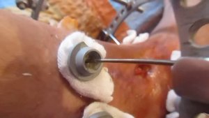 Аппарат Иллизарова. Открытый перелом ноги. 2-я серия.