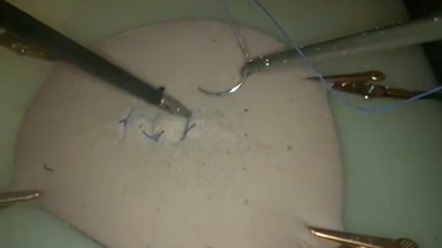 Скользящий интракорпоральный узел (рыбацкий) | Fisher slip knot смотреть онлайн