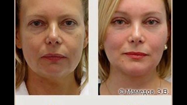 Эффект гуаша до и после фото лица