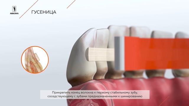 ГУСЕНИЦА - Светоотверждаемая система "композит-волокно-композит" смотреть онлайн