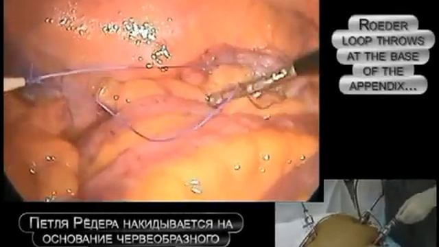 Лапароскопическая аппендэктомия. Laparoscopic Appendectomy