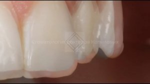 Прямая и полупрямая реставрация передних зубов композитом. iGos и Esthet-X. Front teeth restoration