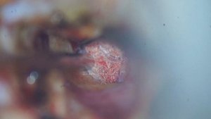 29 - Хирургическое лечение при отосклерозе