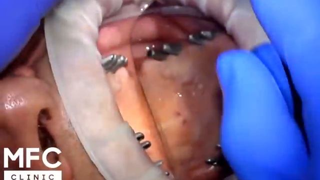 Несъемное протезирование на имплантах. Установили имплантаты и несъемный протез смотреть онлайн