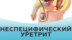 Неспецифический уретрит у мужчин и женщин.