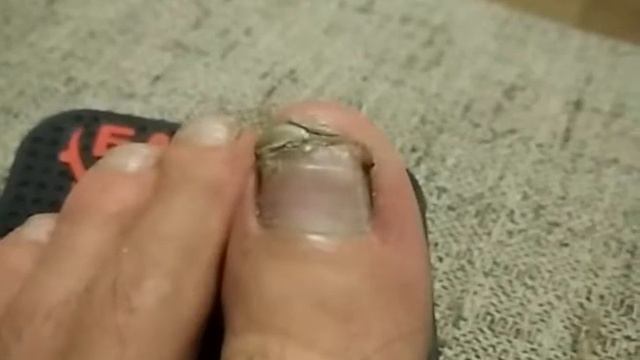 Лечим ноготь без врача. Отбитый ноготь отрастает. часть 12 смотреть онлайн