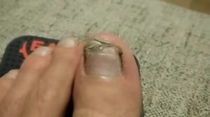 Лечим ноготь без врача. Отбитый ноготь отрастает. часть 12