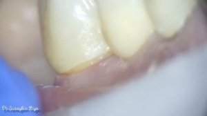 Прилегание по уступу циркониевой коронки на 37 зуб , после фиксации .  Зуб витальный т.е живой!