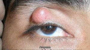 Шишка на брови