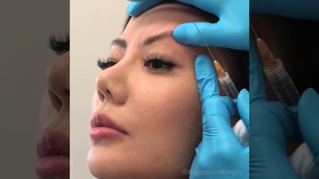 BROW LIFT WITH FILLER "3D BROW" смотреть онлайн