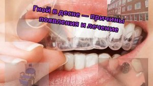 Гной в десне — причины появления и лечение
