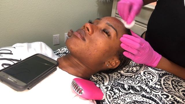 THE SKIN SERIES: Modified Jessner Peel on Client | Treating breakouts and dark marks | Maura Beauty смотреть онлайн