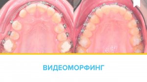 Прогресс в лечении за 15 месяцев - достаем ретинированный зуб из нёба пациента