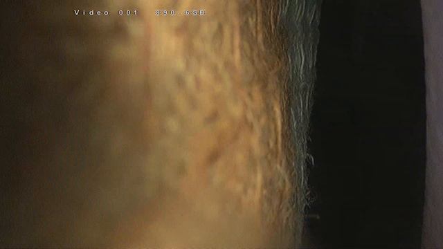 Лапароскопическая резекция сигмовидной кишки с резекцией тонкой кишки мочевого пузыря Видео 9