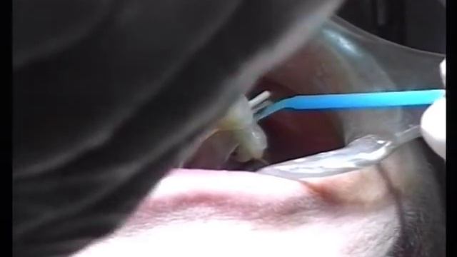 Direct Resin Laminate Veneers смотреть онлайн