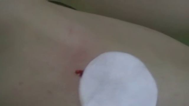 Курсы гирудотерапии видео Окончание сеанса смотреть онлайн