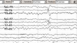 8   interictal abnormalities