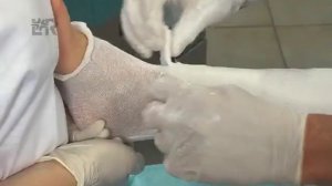 Гипс Целлона повязка на бедро