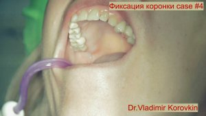 Фиксация коронки из оксида циркония(Pretau ).Кейс #4.