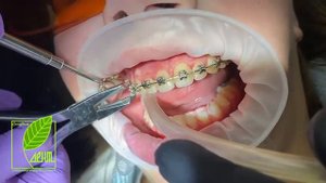 Снятие брекетов и полировка зубов СПб