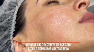 SMAS-лифтинг в клинике "Артевита"