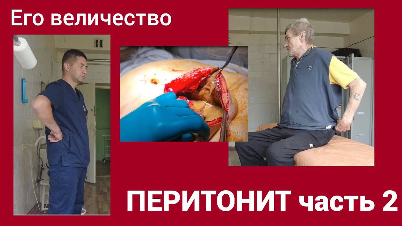 Его величество ПЕРИТОНИТ часть 2