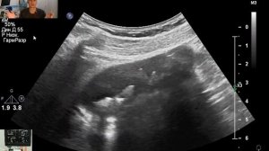 Загиб (перегиб)  желчного пузыря - причина  нарушения  оттока желчи и образования камней ?