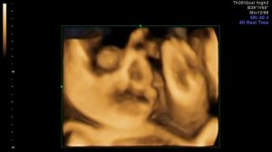 Наш сыночек. Узи 3D, третий скрининг.