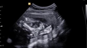 Обычное узи плода в 21 неделю