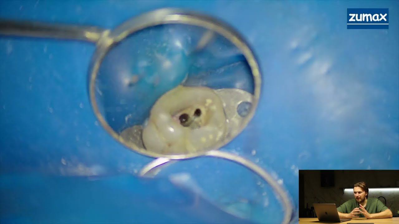 ИЗВЛЕЧЕНИЕ ОТЛОМКА ИЗ КОРНЕВОГО КАНАЛА. САМ СЛОМАЛ-САМ ДОСТАЛ смотреть онлайн