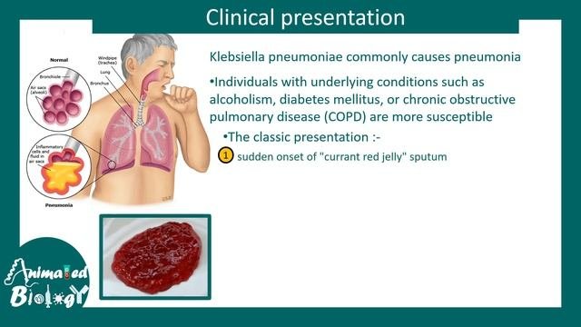 Klebsiella | Klebsiella Pneumoniae | Clinical Presentation, Risk Factors And Treatment Of Klebsiell