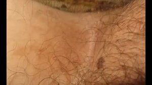 Паховый грибок (грибок в паху)