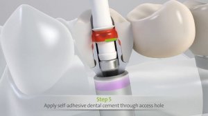 Cementation Aid for Straumann® Variobase® for Bridge/Bar Cylindrical