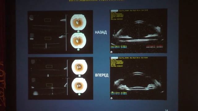 Аксиальные смещения интраокулярных линз смотреть онлайн