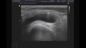 Синовит, жидкость в верхнем завороте