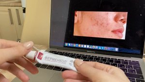 КАК ИЗБАВИТЬСЯ ОТ АКНЕ И ПОСТАКНЭ? Прыщи и шрамы - как убрать?