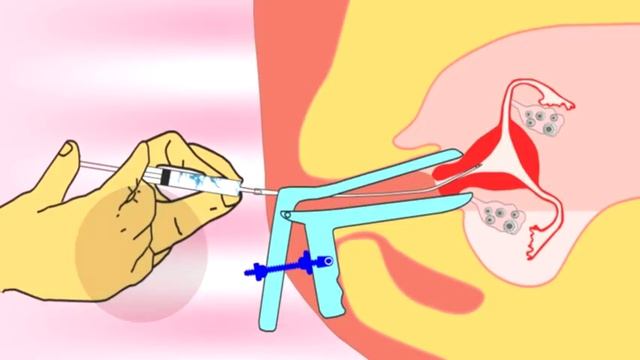 Intrauterine Insemination (IUI), IUTPI, The New Method Of Insemination Video