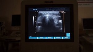 Philips HD3 обзор ультразвукового сканера