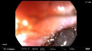 Желудочно кишечное кровотечение.