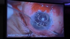 Контузия тяжелой степени с люксацией хрусталика в стекловидное тело