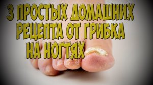 3 простых домашних рецепта от грибка на ногтях