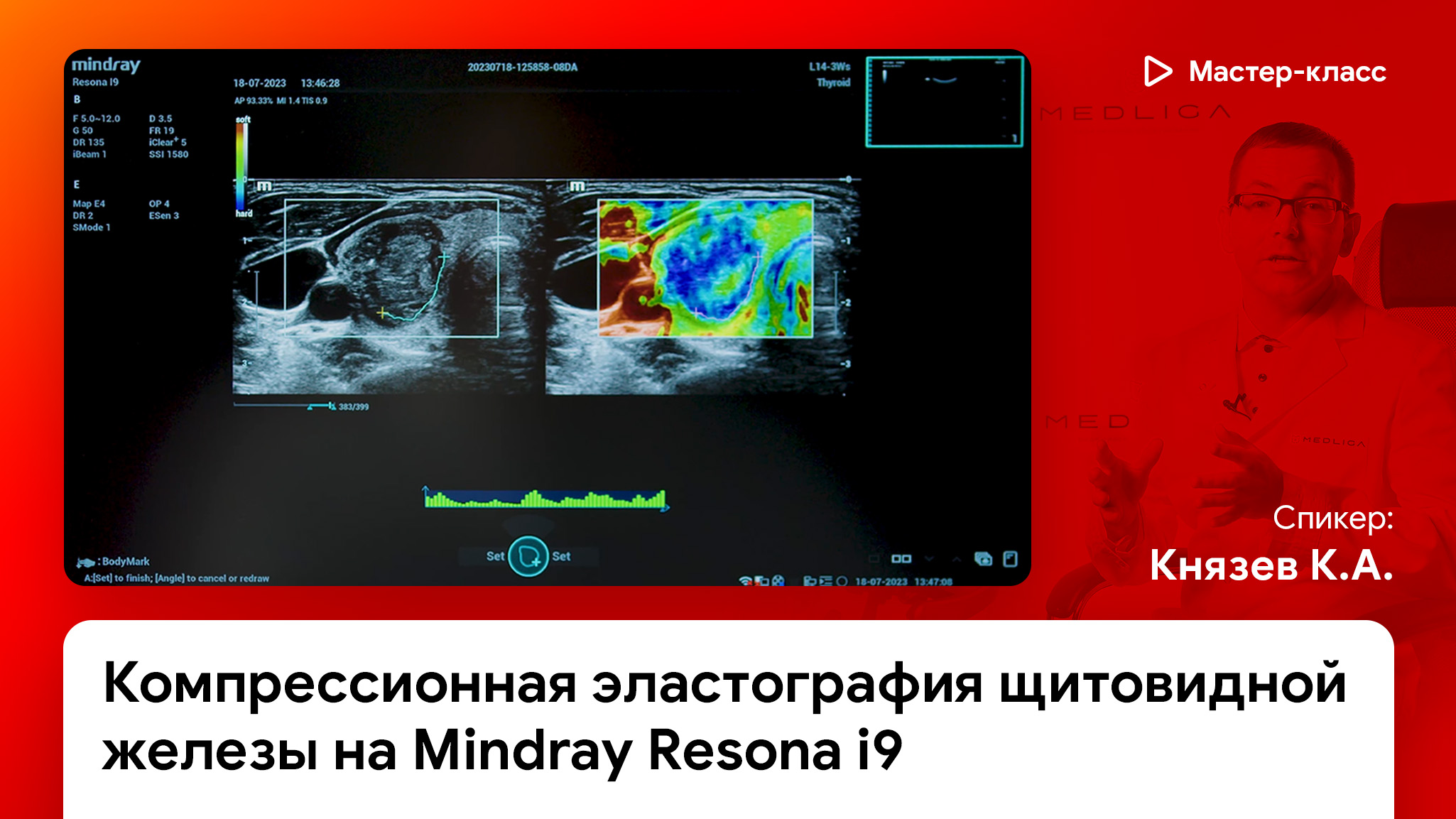 Компрессионная эластография щитовидной железы (Strain Elastography) на Mindray Resona i9