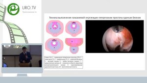 Лазерная энуклеация гиперплазии простаты единым блоком - Дымов А.М.