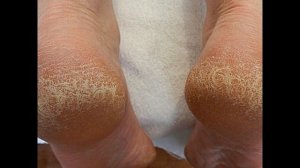 Почему нужно применять перекись водорода на пятки