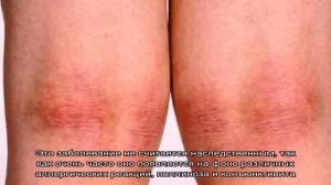 Пеленочный дерматит у детей: симптомы и лечение. Как выглядит пеленочный дерматит?