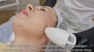 Импульсный РФ-лифтинг: лицо, губы, веки, второй подбородок!