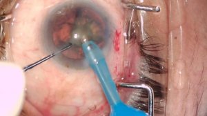 Phacoemulsification of NS3 cataract on Stellaris PC machine by direct chop