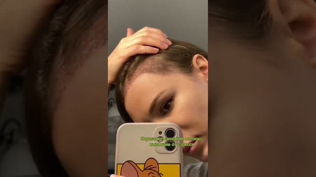 Результат пересадки волос спустя 3 месяца!! смотреть онлайн